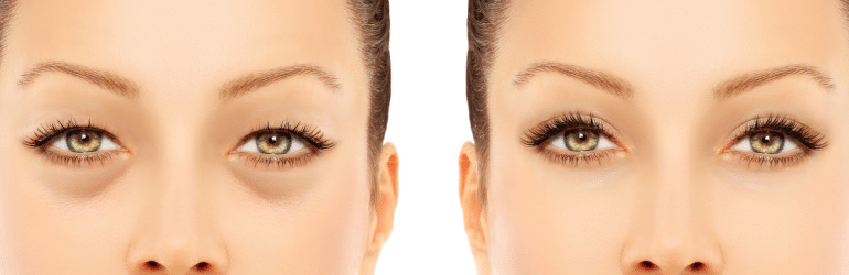 Eyelid Surgery: How Blepharoplasty Can Brighten Your Eyes